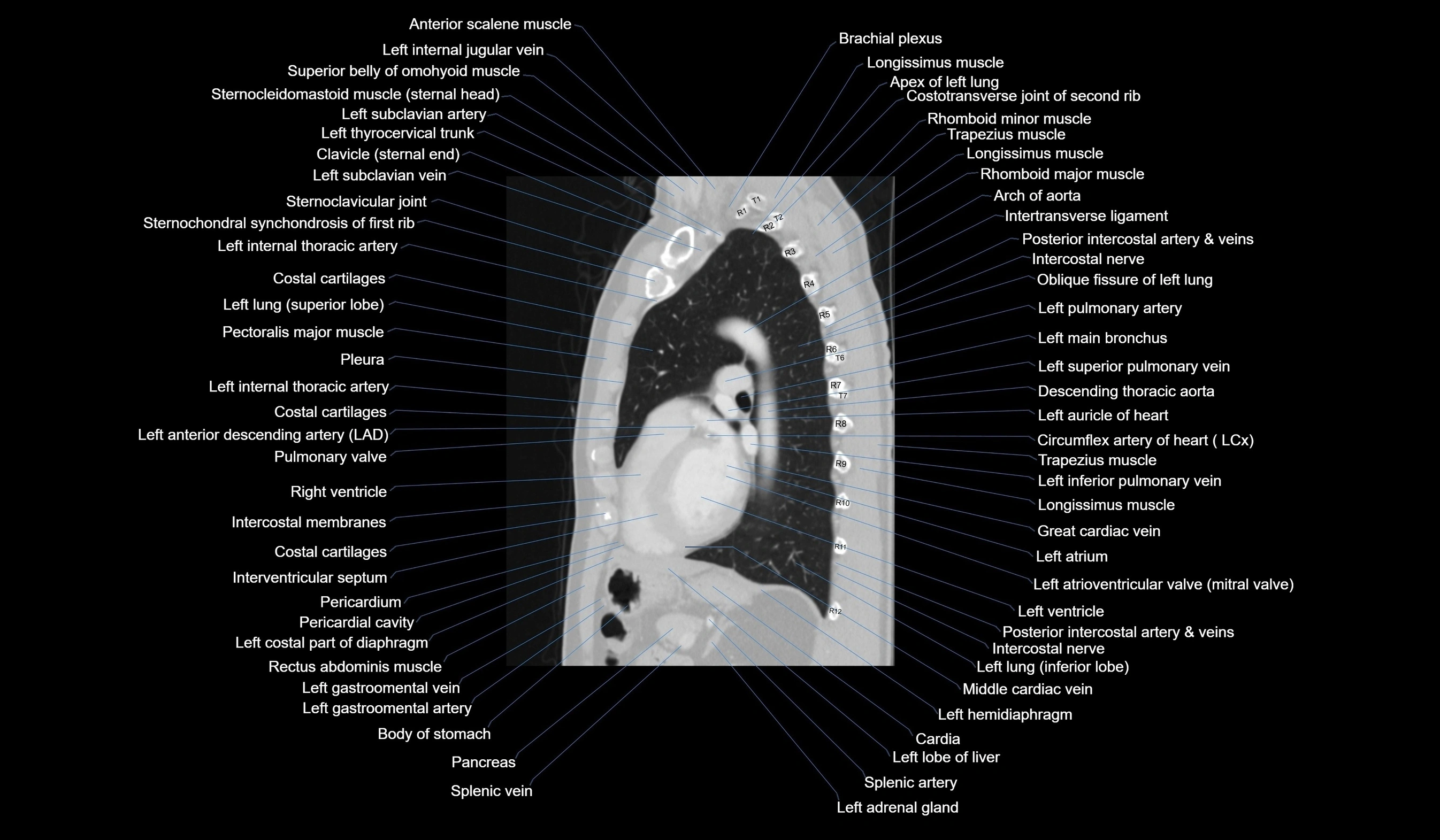 CT chest (thorax) labelled sagittal cross sectional anatomy radiology image-00088.webp